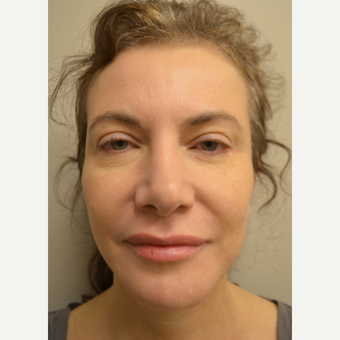 45-54 year old woman treated with Mini Facelift with Neck Liposuction and Chin Implant after 3371353