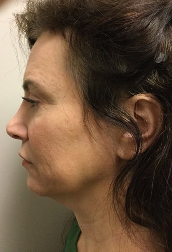 45-54 year old woman treated with Mini Facelift with Neck Liposuction and Chin Implant 3371353