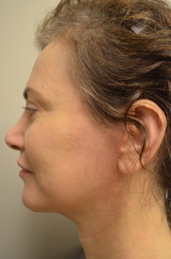 45-54 year old woman treated with Mini Facelift with Neck Liposuction and Chin Implant 3371353