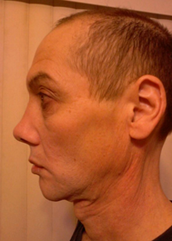 Transgender FFS Facial Feminization Rhinoplasty, Lip Enhancement VY Advancement after 1423901