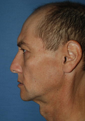Transgender FFS Facial Feminization Rhinoplasty, Lip Enhancement VY Advancement before 1423901