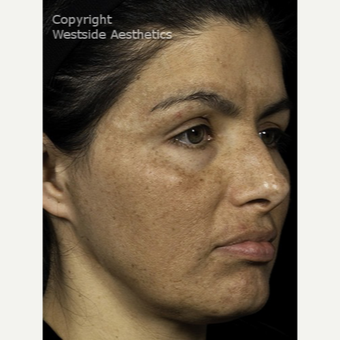Fraxel for Sever Hyperpigmentation after 3065410