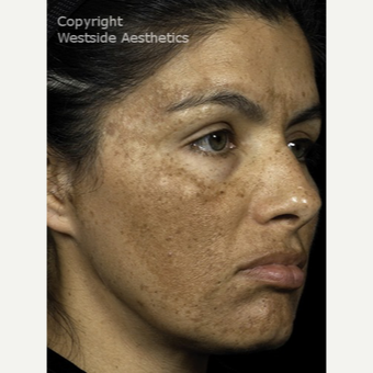 Fraxel for Sever Hyperpigmentation before 3065410