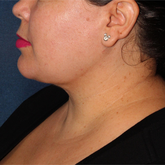 40 year old woman treated with Liposculpture to the neck area after 3420177