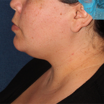 40 year old woman treated with Liposculpture to the neck area before 3420177