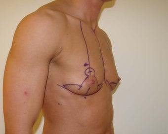 "Top Surgery" FTM chest masculinization 867221