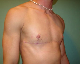 "Top Surgery" FTM chest masculinization 867221