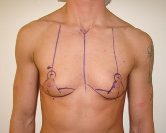 "Top Surgery" FTM chest masculinization before 867221