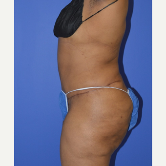 55-64 year old woman treated with No-Drain Tummy Tuck after 3655723