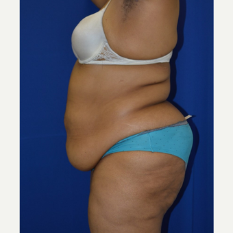 55-64 year old woman treated with No-Drain Tummy Tuck before 3655723
