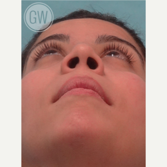 25-34 year old woman treated with Rhinoplasty before 3472405