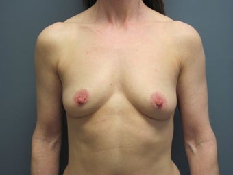 Breast Augmentation on 49 Year Old before 1114882