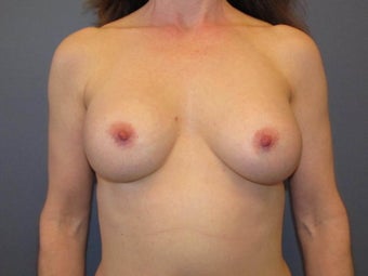 Breast Augmentation on 49 Year Old after 1114882