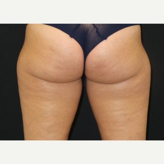 25-34 year old woman treated with CoolSculpting before 2407257