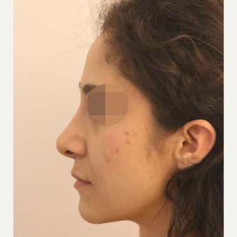 25-34 year old woman treated with Rhinoplasty after 3522473