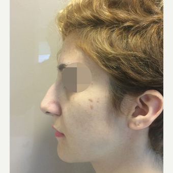 25-34 year old woman treated with Rhinoplasty before 3522473