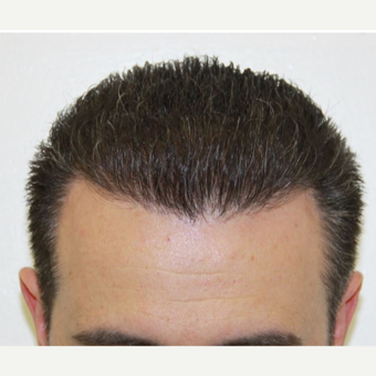 Repair Case: FUE Hair Restoration with Dr. Baubac after 3645929