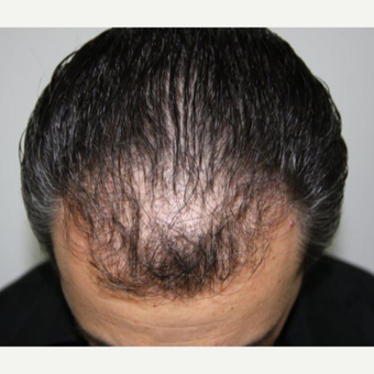 Repair Case: FUE Hair Restoration with Dr. Baubac before 3645929