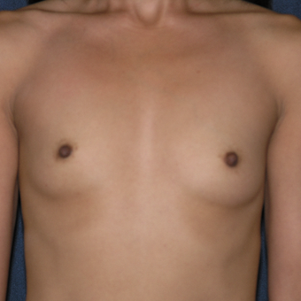 45-54 year old woman treated with Sientra Breast Implants before 3454487
