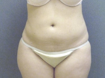 SmartLipo tummy and hip roll - laser assisted after 607520