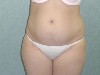 SmartLipo tummy and hip roll - laser assisted before 607520