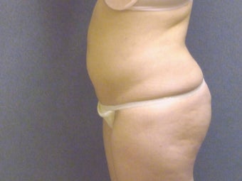 SmartLipo tummy and hip roll - laser assisted 607520