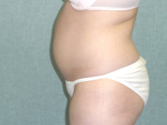 SmartLipo tummy and hip roll - laser assisted 607520