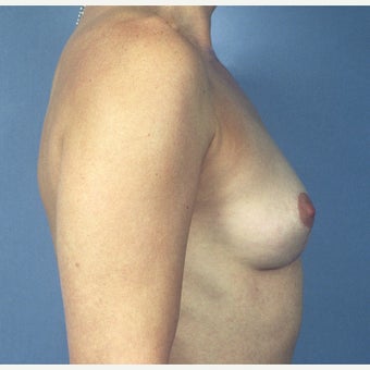35-44 year old woman treated with Breast Implant Removal and Mastopexy (Breast Lift) 1819342