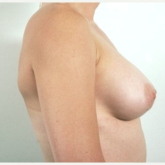 35-44 year old woman treated with Breast Implant Removal and Mastopexy (Breast Lift) 1819342