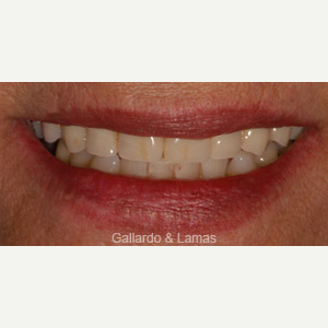 65-74 year old woman treated with All-on-4 Dental Implants after 3093908