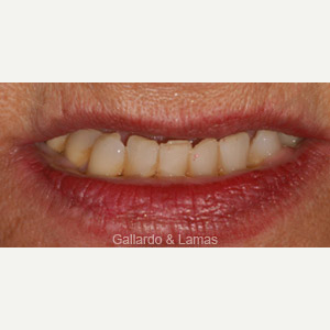 65-74 year old woman treated with All-on-4 Dental Implants before 3093908