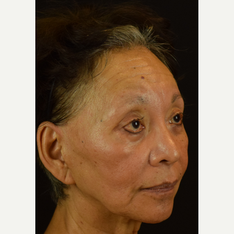 Jawline Enhancement and Marionette (Corner of the Mouth) Tightening before 3691746