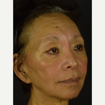 Jawline Enhancement and Marionette (Corner of the Mouth) Tightening after 3691746