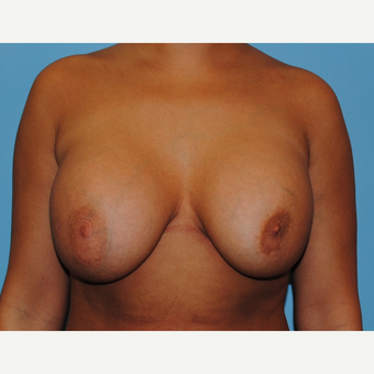 31 year old woman treated with Breast Implant Revision, Mastopexy and implant exchange, 430 cc before 3506912