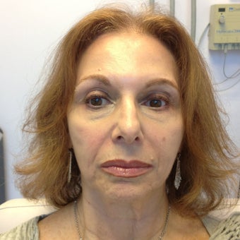 55-64 year old woman treated with Liquid Facelift before 2293273