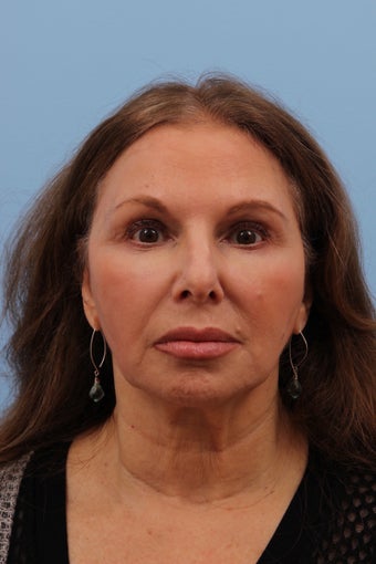 55-64 year old woman treated with Liquid Facelift after 2293273