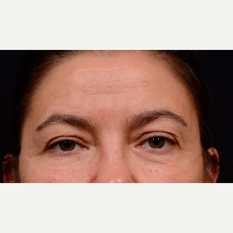 55-64 year old woman treated with Brow Lift before 3776177