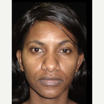 25-34 year old woman treated with African American Rhinoplasty before 1741587