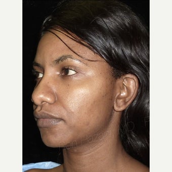 25-34 year old woman treated with African American Rhinoplasty 1741587