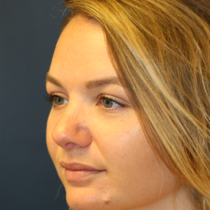 25-34 year old woman treated with Rhinoplasty after 3559757
