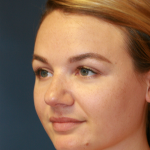 25-34 year old woman treated with Rhinoplasty before 3559757