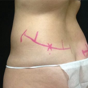 25-34 year old woman treated with CoolSculpting after 3140459