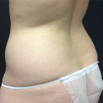 25-34 year old woman treated with CoolSculpting before 3140459