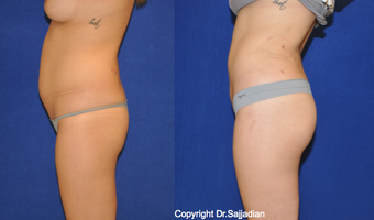 Butt Augmentation before 1262617