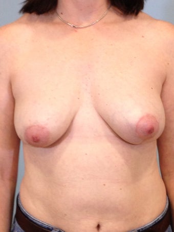 41 year-old woman undergoes bilateral implant removal, left breast lift, and right breast fat grating for old implants after 1146228