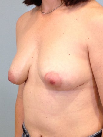 41 year-old woman undergoes bilateral implant removal, left breast lift, and right breast fat grating for old implants 1146228
