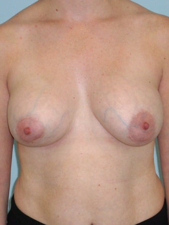 41 year-old woman undergoes bilateral implant removal, left breast lift, and right breast fat grating for old implants before 1146228