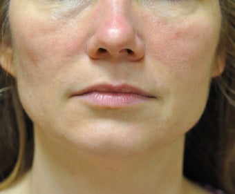 43 Year Old Woman treated with Ultherapy and Sculptra after 1026748