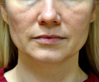 43 Year Old Woman treated with Ultherapy and Sculptra before 1026748