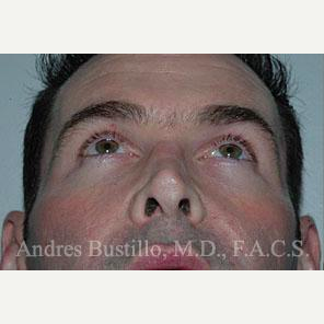 25 year old man treated with Revision Rhinoplasty before 3460638